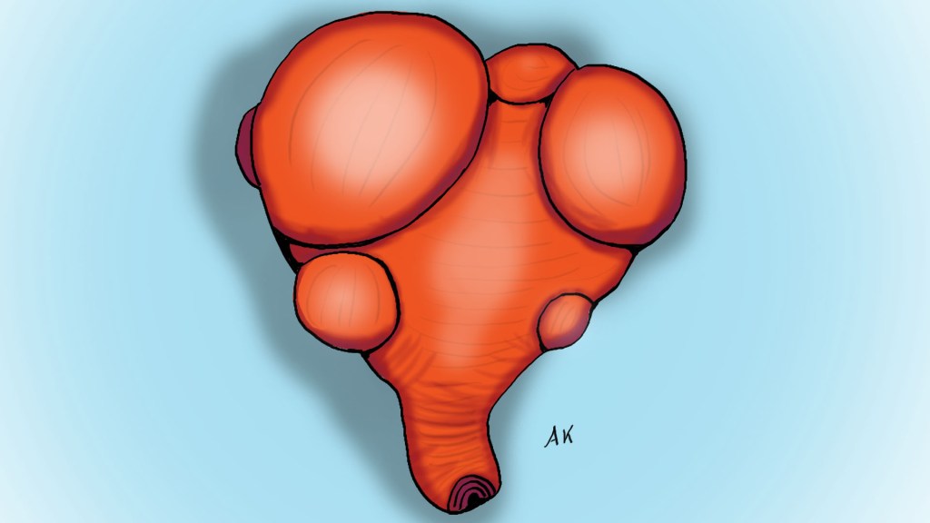 ινομυώματα μήτρας