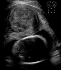 Ινομύωμα εγκυμοσύνη