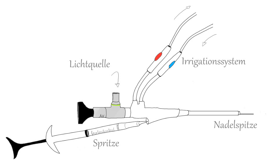 Περιουρηθρικές ενέσεις Bulkamid