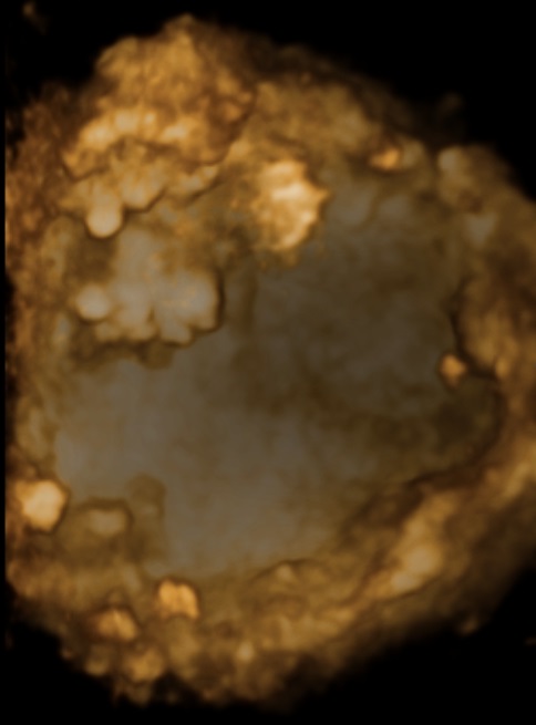 καρκίνος ενδομητρίου