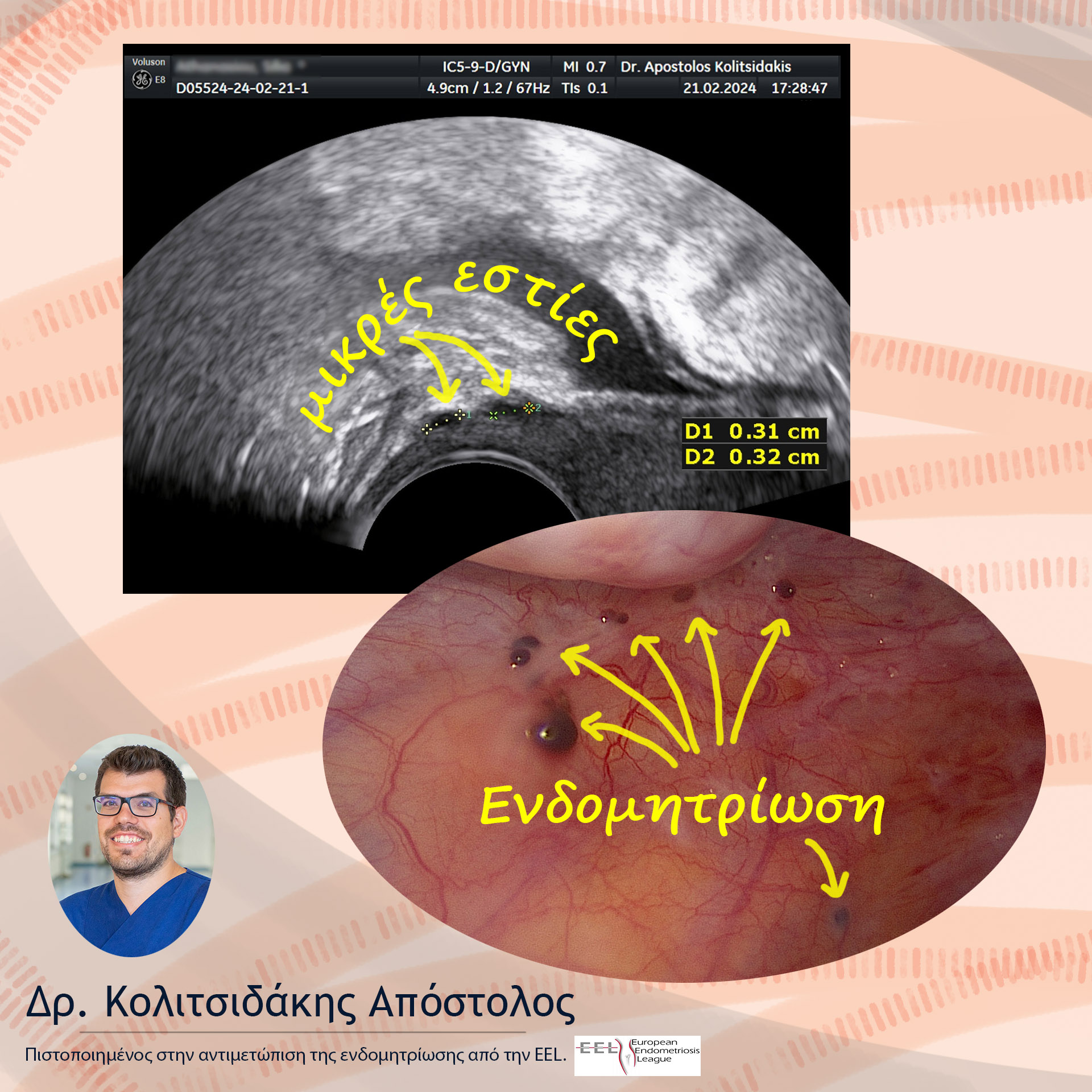 ειδικός στην ενδομητρίωση