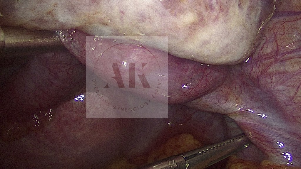 συστροφή ωοθήκης λαπαροσκόπηση