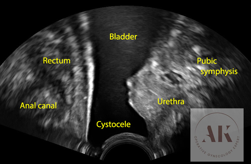 κυστεοκήλη στον υπέρηχο