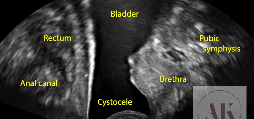 κυστεοκήλη στον υπέρηχο