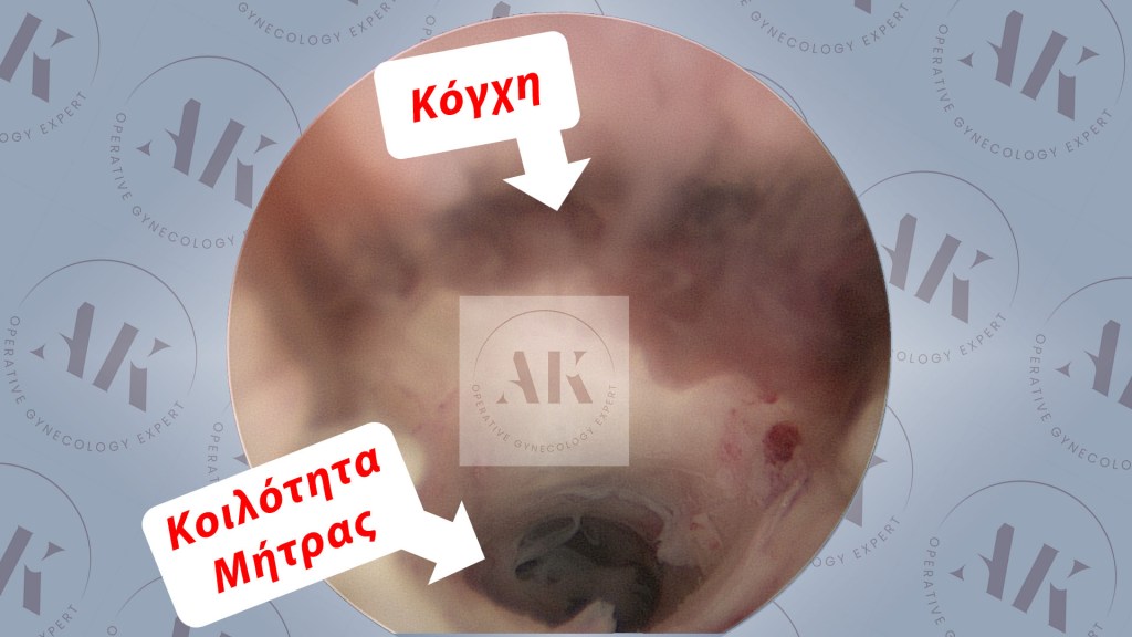 Κόγχη καισαρικής ουλής
