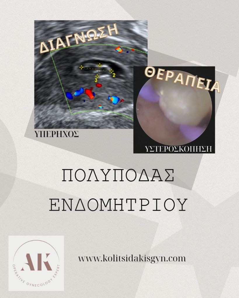 πολύποδας ενδομητρίου