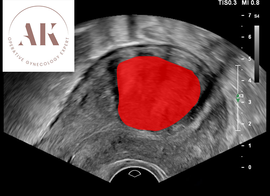 ινομύωμα στον υπέρηχο