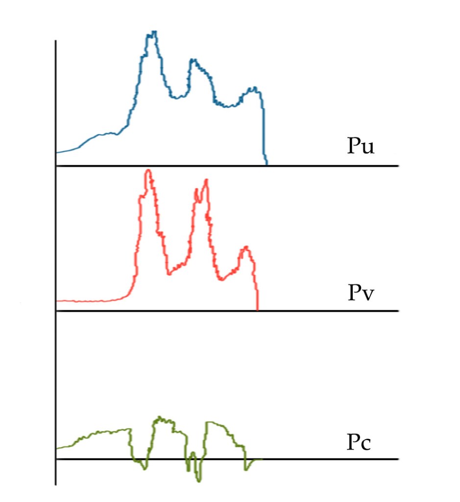 ουροδυναμικός έλεγχος σε ακράτεια ούρων σε προσπάθεια