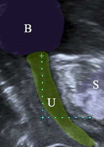 ουρήθρα ουροδόχος κύστη υπέρηχος