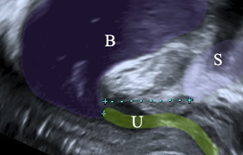 ακράτεια ούρων σε προσπάθεια υπέρηχος