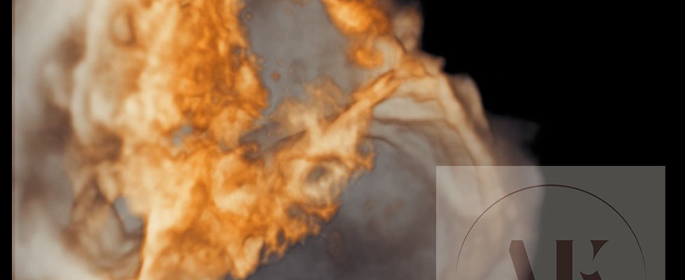 καρκίνος ωοθηκών στον υπέρηχο