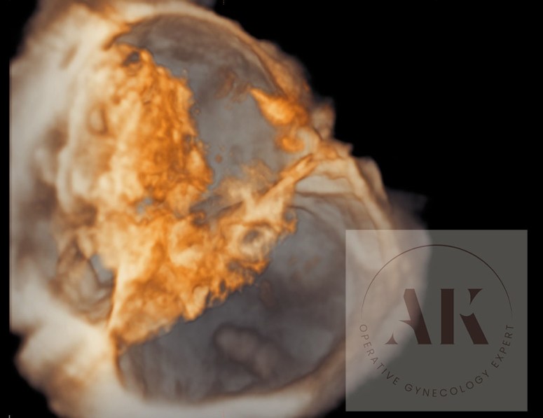 καρκίνος ωοθηκών στον υπέρηχο