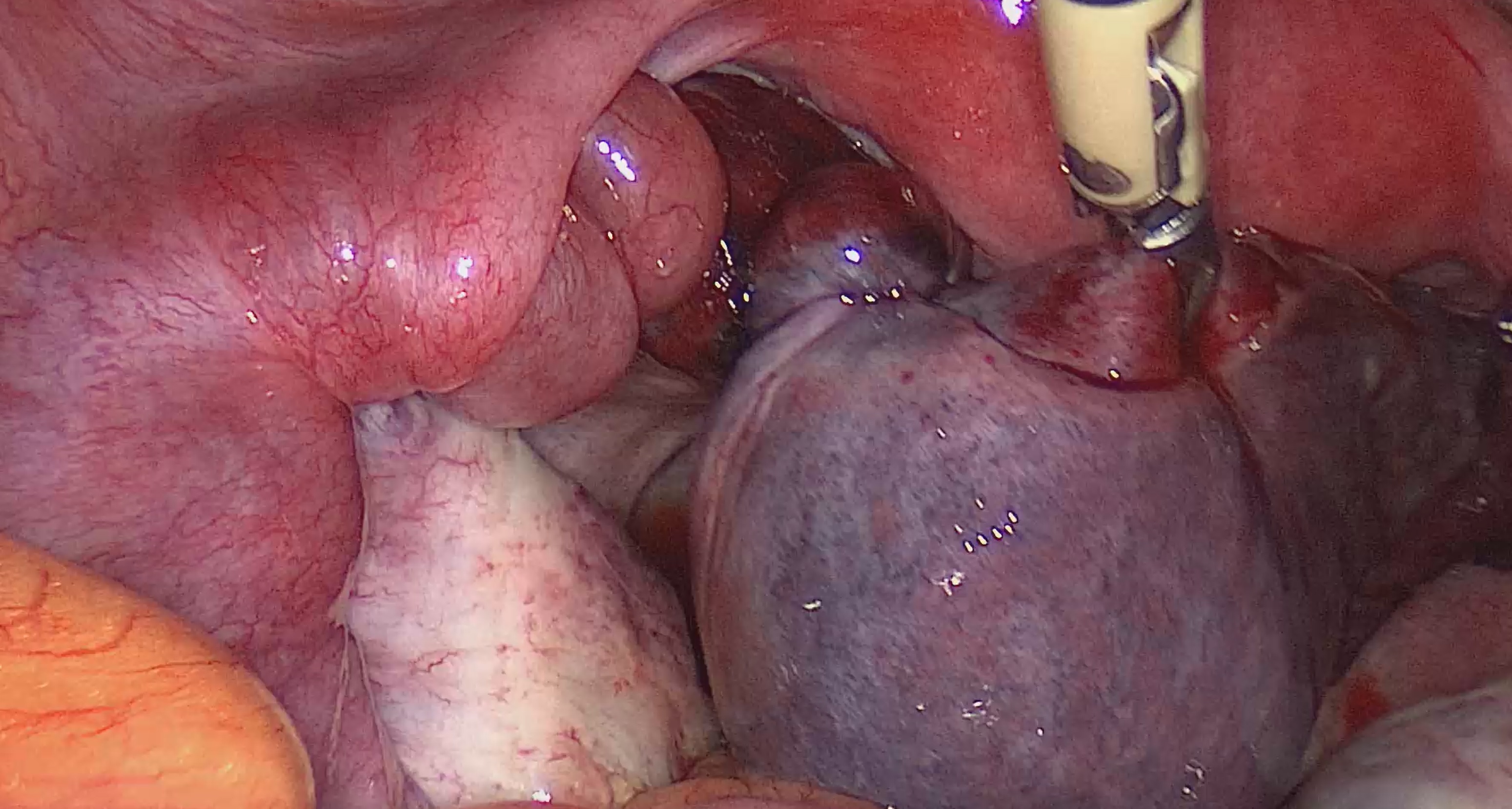 συστροφή σάλπιγγας λαπαροσκοπικά