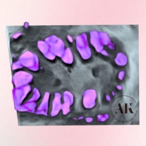 πολυκυστική ωοθήκη υπέρηχος